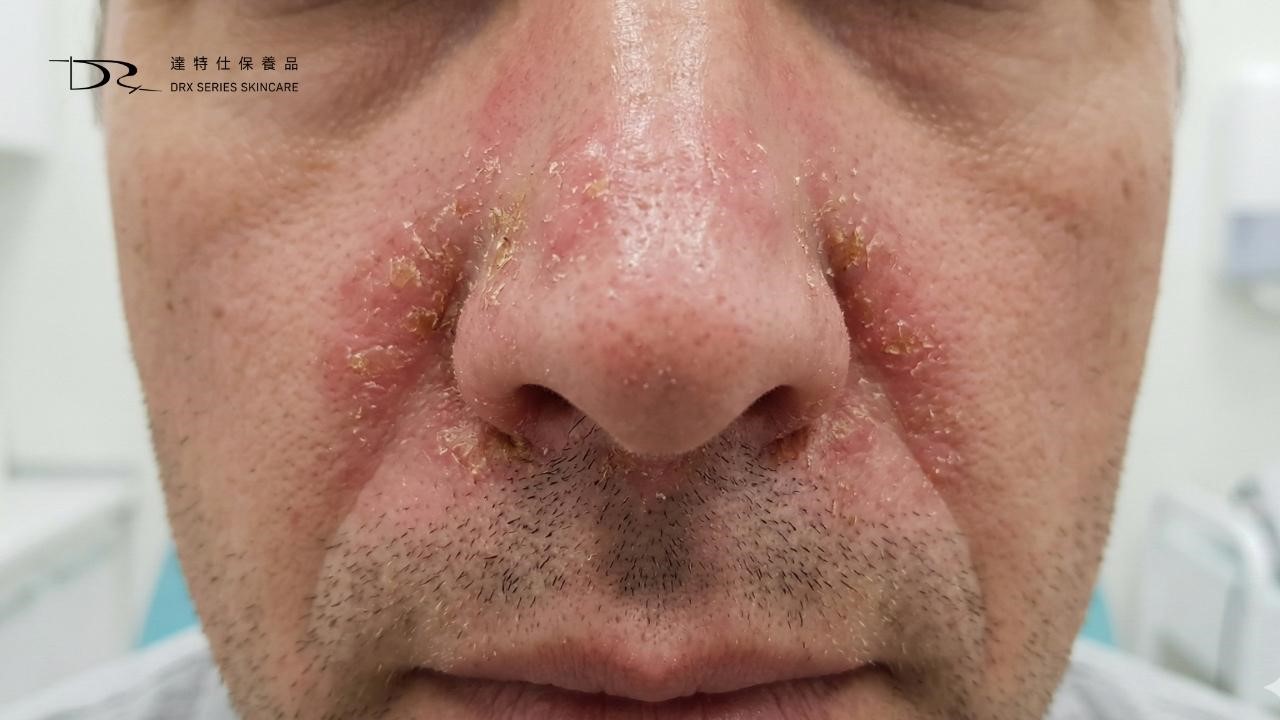 鼻翼為什麼會脫皮？可能是脂漏性皮膚炎！