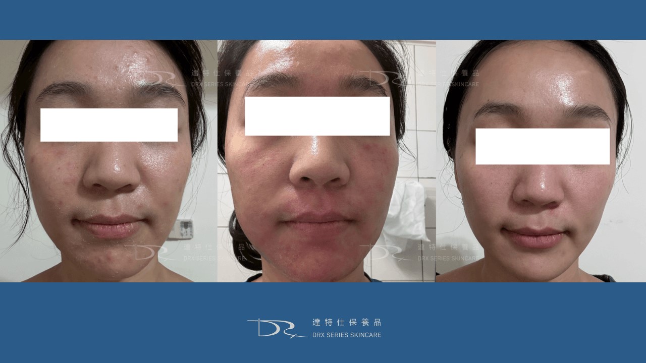 抗老最有效成分？30歲40歲抗老保養品？如何淡斑最有效？